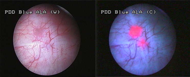 Bladder Cancer